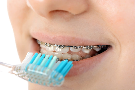 Teenager mit fester Zahnspange bei Zahnpflege mit Zahnbürste