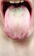 Disease  infection tongue