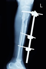 closed fracture tibia and fibula left lef