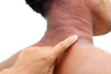 Fototapeta premium Allergy rash