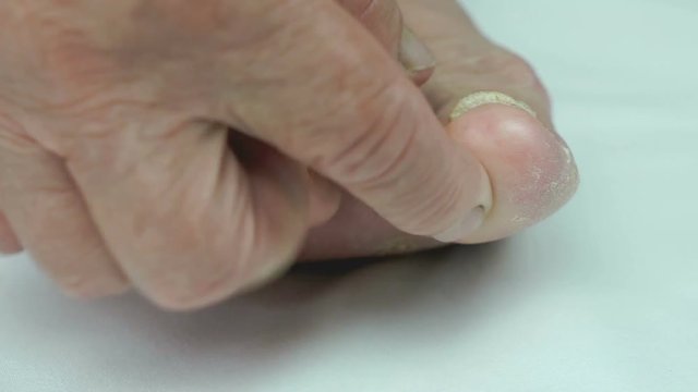 Fungus infection nails of person's foot