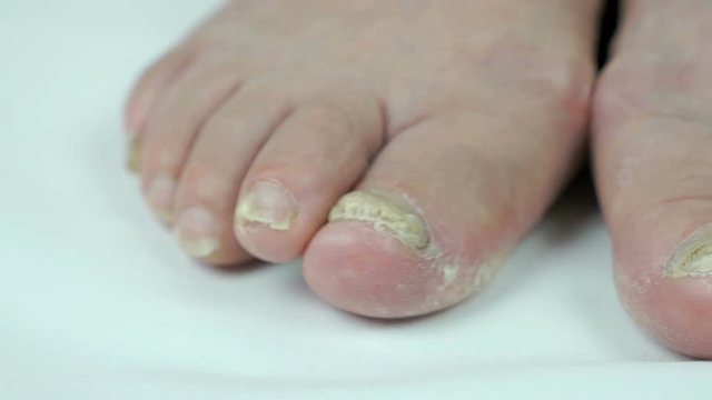 Fungal infections of feet of old woman