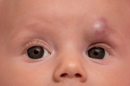 Infant hemangioma on forehead of baby girl, treatment with propr