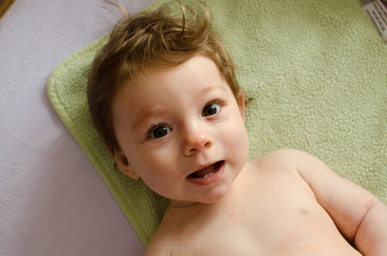  Roseola infantum