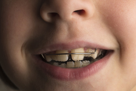 Girl wearing an orthodontic dental apparatus