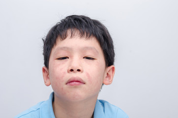 Closeup face of young asian boy with rash from allergy