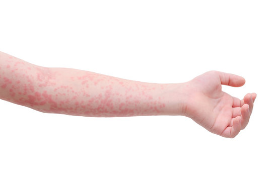 Young asian child arm skin with rash over white background
