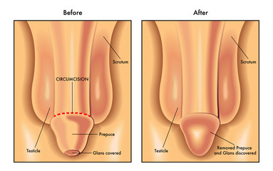circumcision