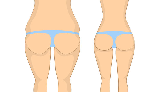Before and after buttocks. Fat butt with cellulit before and sexy slim tight ass after. Body correction using fitness exercises at gym or plastic syrgery.