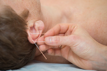 Photo of acupuncture treatments, placement of medical needles on the patient, close-ups