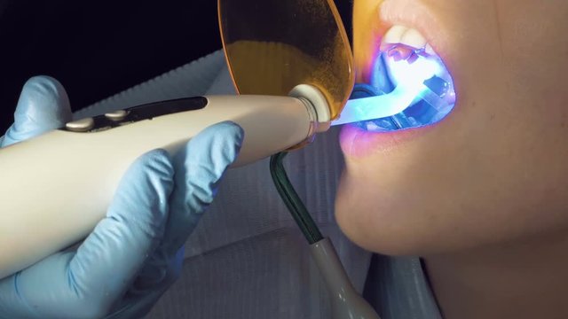 Woman at dentist clinic gets dental treatment to fill a cavity in a tooth. Dental restoration and material polymerization with UV light. Odontic and mouth health is real protection from caries decay.