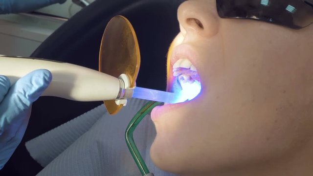 Woman at dentist clinic gets dental treatment to fill a cavity in a tooth. Dental restoration and material polymerization with UV light. Odontic and mouth health is real protection from caries decay.