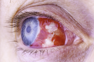 Macro image of a red bloodshot eye