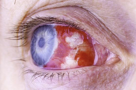 Macro image of a red bloodshot eye