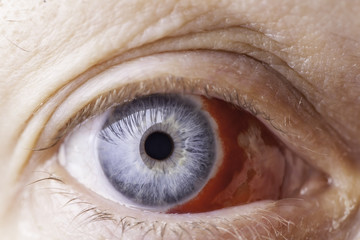 Close up of red bloodshot eye