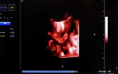 Colourful ultrasound monitor image. Fetral face, Virtual HD