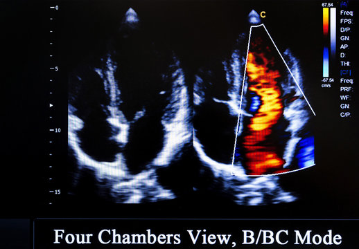Colourful ultrasound monitor image. Four Chambers View