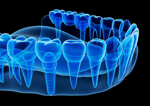 X-ray view of denture with implant