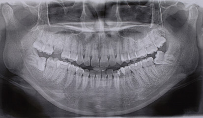 Panoramic dental X-Ray
