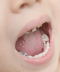 baby teeth with caries