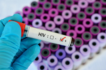 Obraz premium Blood sample positive with HIV test 