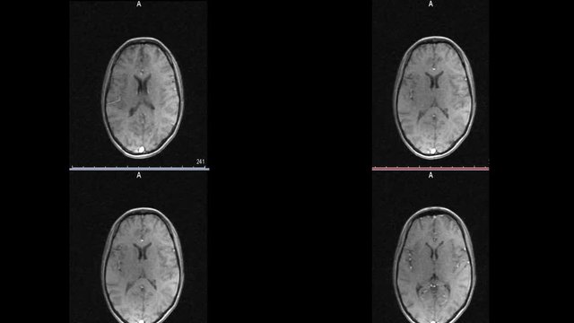 Magnetic resonance imaging of the brain sclerosis microstroke white spots in the brain