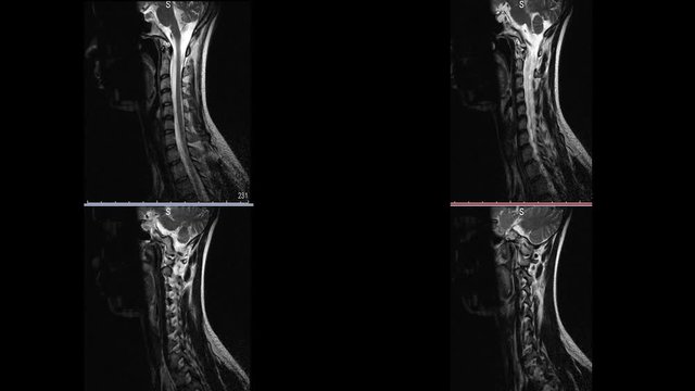Magnetic resonance imaging neck of the brain sclerosis microstroke white spots in the brain