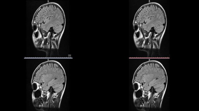 Magnetic resonance imaging of brain sclerosis microstroke white spots in the brain