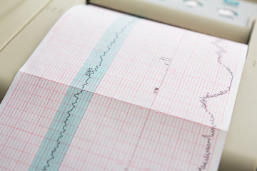 Printing of cardiogram report coming out from Electrocardiograph in labour ward