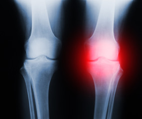 Xray knee joint trauma