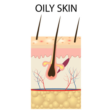 Illustration Of The Layers Of Oily Skin