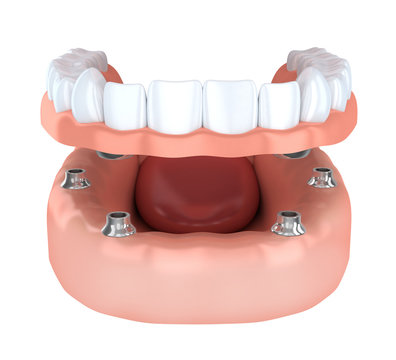 Tooth Implantation, Denture