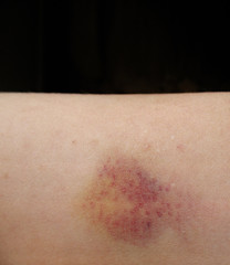Fototapeta premium Bruised Arm Isolated on Black