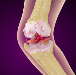 Osteoporosis of the knee joint,  Medically accurate 3D illustration