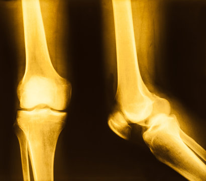 film X-ray image of Knee