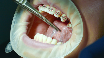 Patient at a reception at the dentist. Oral cavity close-up