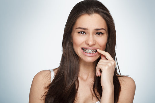 Face of a young woman with braces on her teeth