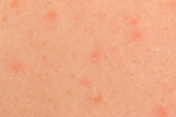 red spots on the skin