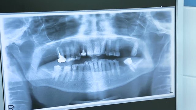 x-ray image of teeth