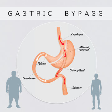 gastric bypass surgery