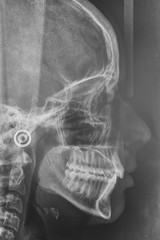 Maxilofacial X-Ray for a dentist treatment. Orthodontics diagnos