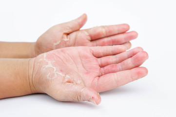 Dry hands, peel, Contact dermatitis, fungal infections, Skin inf
