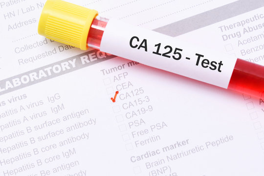 Blood for CA 125 test, tumor marker for ovarian cancer Stock Photo | Adobe  Stock