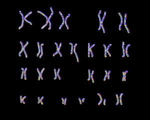 Philadelphia chromosome karyotype male or female. 3D illustration showing defective 9 and 22 chromosomes with translocational defect which causes cause chronic myelogenous leukaemia
