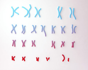 Philadelphia chromosome karyotype male or female. 3D illustration showing defective 9 and 22 chromosomes with translocational defect which causes cause chronic myelogenous leukaemia