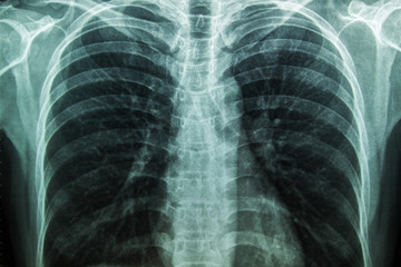 X-Ray Image Of Human Chest for a medical diagnosis