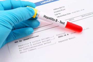 Hepatitis B testing result with blood sample