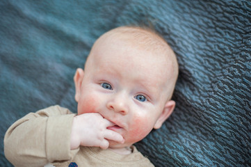 Red-haired boy with atopic dermatitis sucking finger