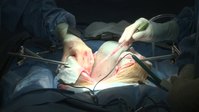 Modern surgery and hands - open chest. 

(Filmed in ProRes with high dynamic range for flexibility for image grading)