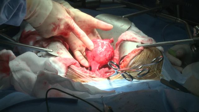 Surgery: large cyst is removed from open chest procedure. 

(Filmed in ProRes with high dynamic range for flexibility for image grading)